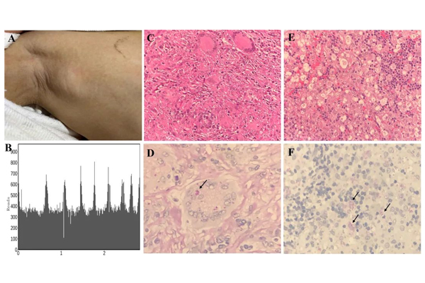 CD Fei Academic | mNGS Technology Rapid Diagnosis of Cyanobacterium marneffei Infection in a Chinese Birth Immunodeficiency Cohort